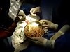 Doctors Remove A Looootta Worms From A Patient