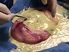 The Nastiest Fucking Teratoma Tumour Ever Ever Ever