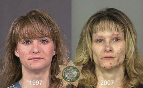 Before And After Meth 18