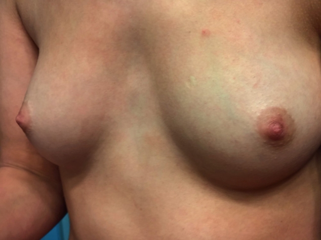 Small Areola 14