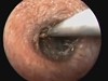 Bug Removal From A Human Ear Is More Horrifying Than You Would Imagine