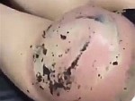 Get A Bigger Butt With One Simple Treatment
