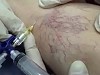 How They Get Rid Of Spider Veins Now