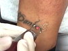 Laser Tattoo Removal Is All Too Easy