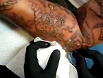 Laser Tattoo Removal Leaves Your Skin A Mess
