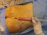 Liposuction Procedure Is A Horror Show

