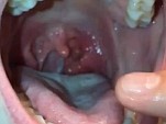 Pops A Sickening Throat Cyst WTFFFFF
