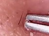 Pore Squeezing At 50 Times Magnification