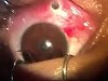 Surgeon Very Carefully Removes Something From An Eye