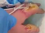 Surgical Blister Removal

