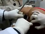 Surgical Intervention Required To Make An Anal Extraction

