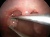 Tonsil Removal Operation Is Totally Disgusting