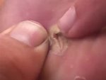When You Get A Splinter Pull It Out Don't Just Leave It
